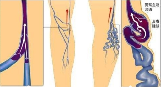 成都川蜀血管病互联网医院：认识深静脉曲张的危害与治疗，助您获得专业护